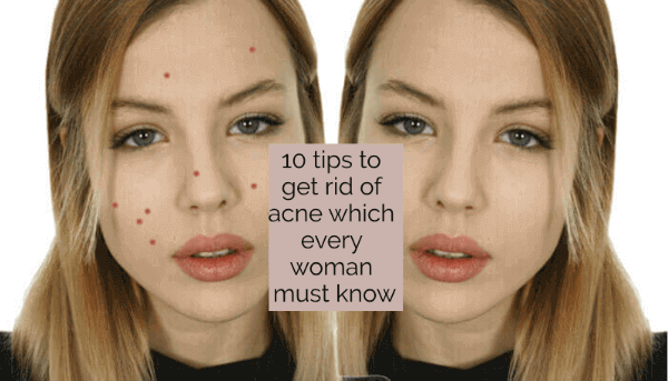 10 tips to get rid of acne which every woman must know