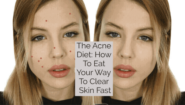 The Acne Diet: How To Eat Your Way To Clear Skin Fast